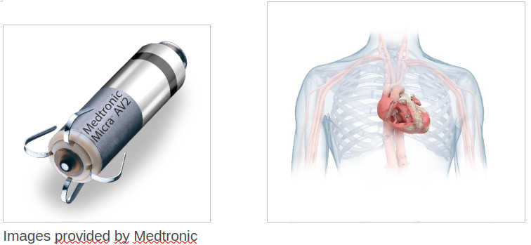 Le Pacemaker Sans Sonde (Leadless Pacemaker)