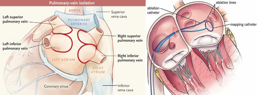 Ablation de la Fibrillation Atriale (FA)