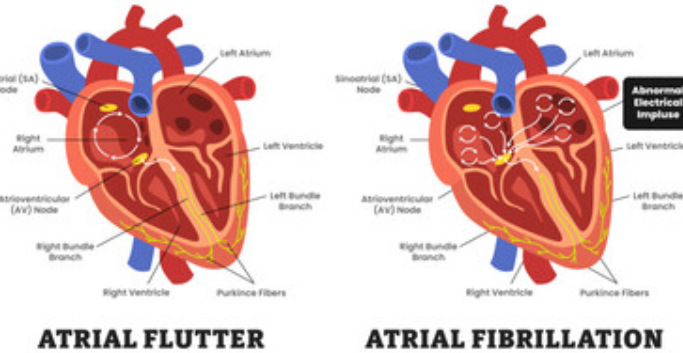 Ablation du Flutter Atrial Commun