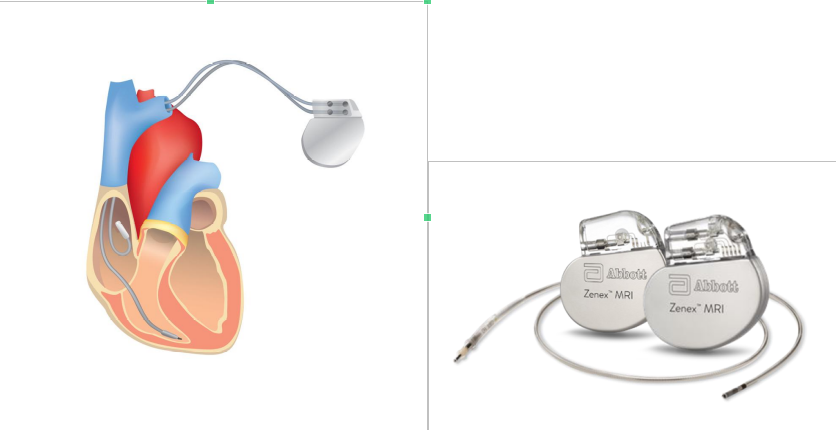 Le Stimulateur Cardiaque Classique (Pacemaker conventionnel)