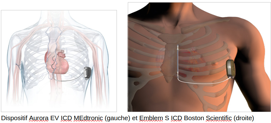Le Pacemaker Sans Sonde (Leadless Pacemaker)
