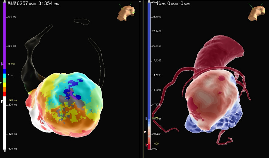 Ablation de la Tachycardie Ventriculaire (TV)